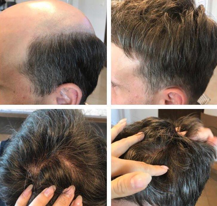 Męski system z włosów syntetycznych 5–10 cm – baza 21x15,5