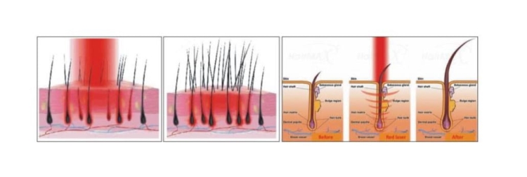 Zabieg trychologiczny trychokombajnem